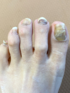 抗がん剤４クール目の投与から4か月後の足爪写真