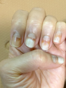 抗がん剤４クール目の投与から１か月後の爪の写真