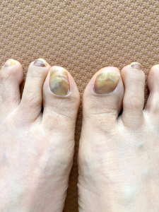 抗がん剤４クール目の投与から３か月後の足爪写真