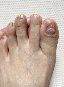 抗がん剤４クール目の投与から５か月後の足爪写真