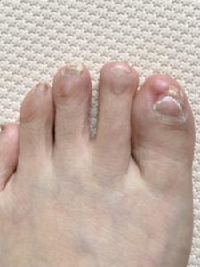 抗がん剤４クール目の投与から６か月後の足爪写真