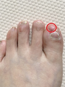 抗がん剤４クール目の投与から６か月後の足爪写真の痛い部分