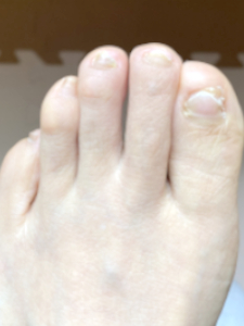 抗がん剤４クール目の投与から７か月後の足爪写真