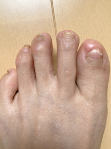 抗がん剤４クール目の投与から８か月後の足爪写真